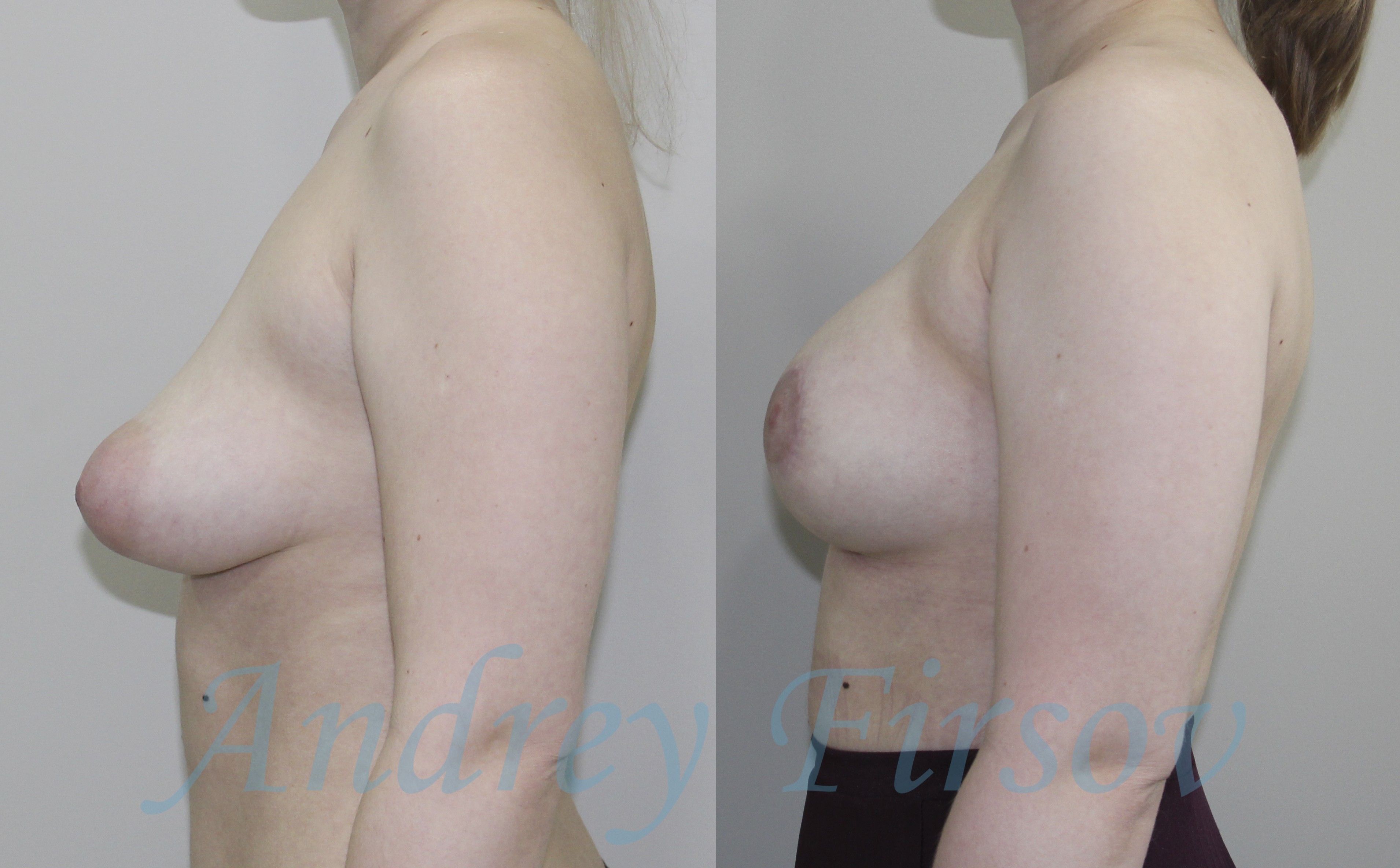 тубулярная деформация груди у женщин фото 102