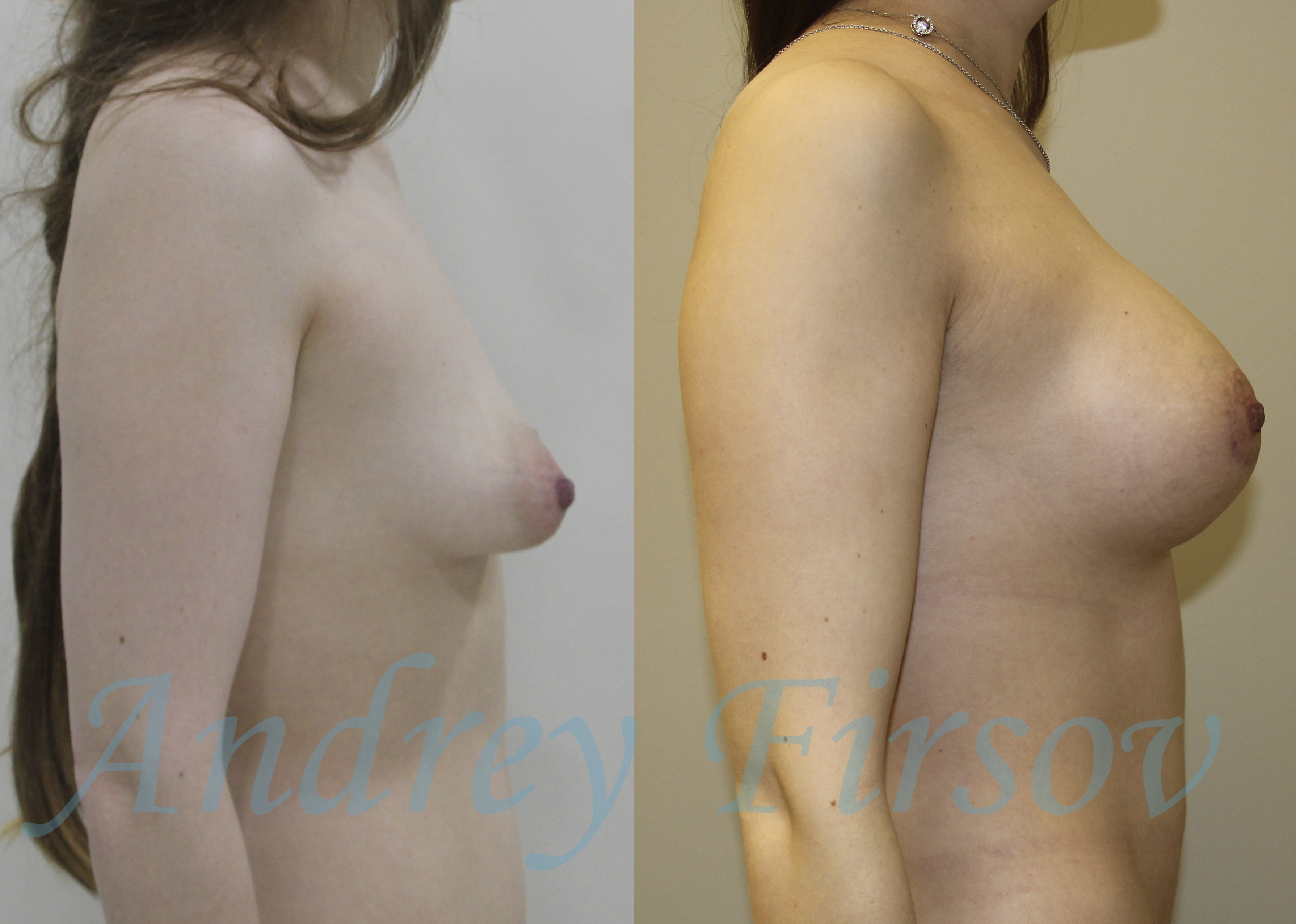 голая грудь после родов фото до и после фото 91